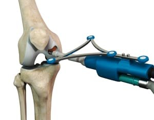 robotic-arthritis-Dr-V-Rajkumar